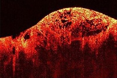 Image of a sarcoma taken with an imaging system based on Optical Coherence Tomography (OCT) 